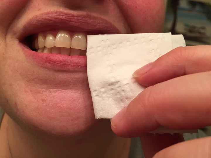  Teeth Whitening - 3