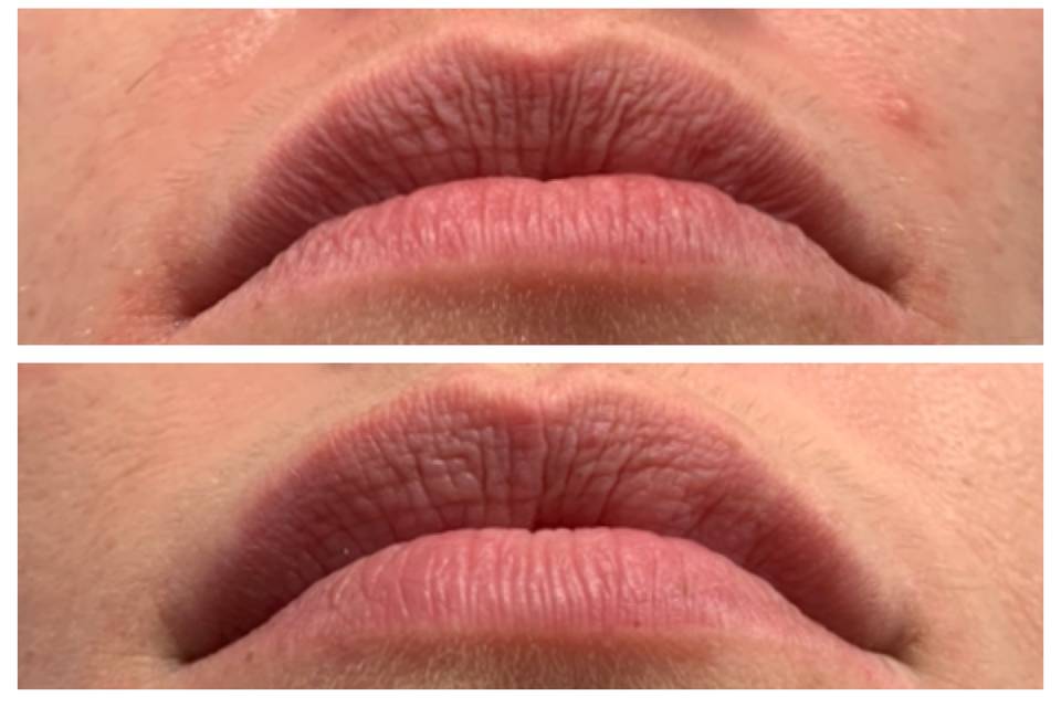 Lip Plumping Treatment