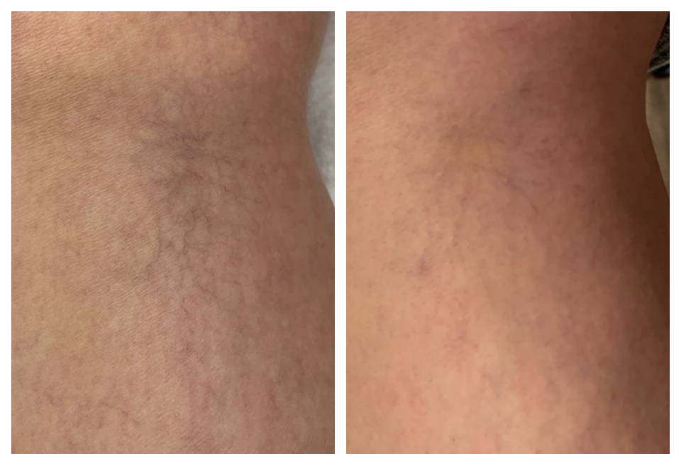 Vein Treatment