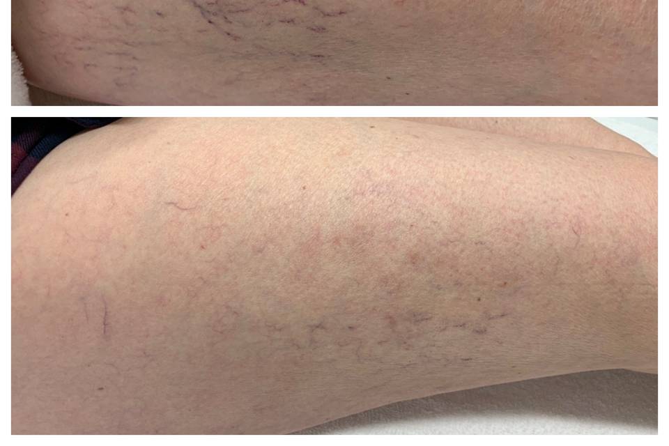 Vein Reduction