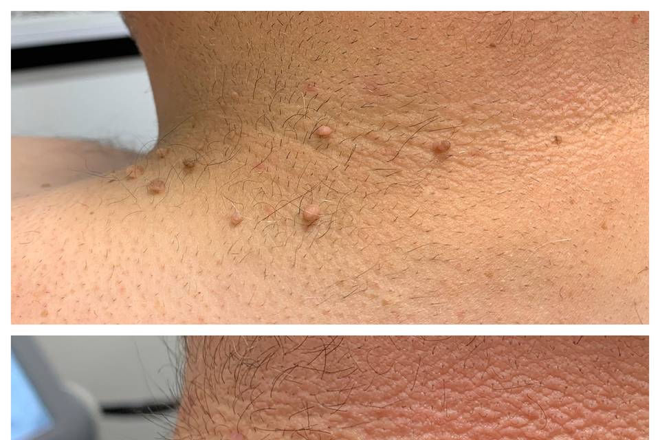 Skin Tag Removal