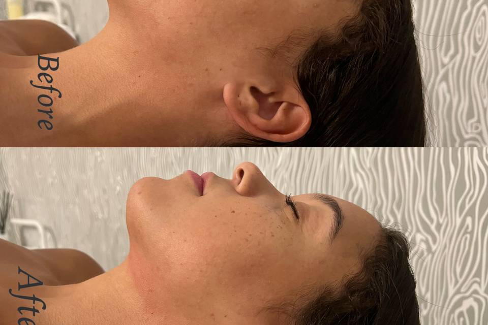 Face lymph drainage