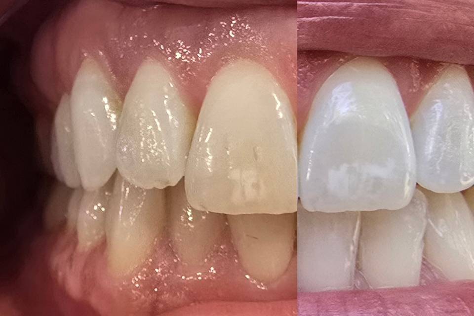 Cosmetic Whitening: 1 session!