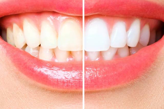 Pro Glow Teeth Whitening