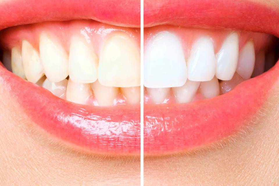 Pro Glow Teeth Whitening