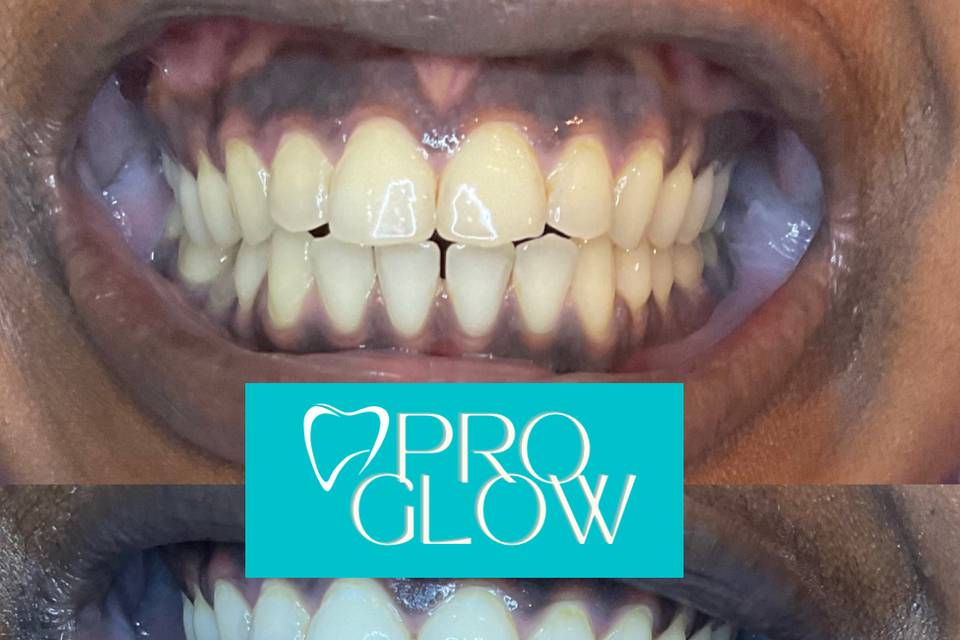 Pro Glow Teeth Whitening