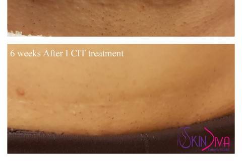 MIcroneedling - Scars