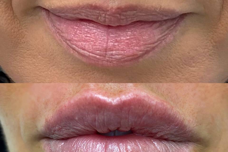 Mini lip augmentation