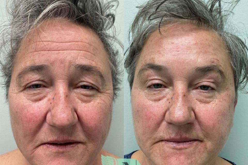 Before and after dermal filler